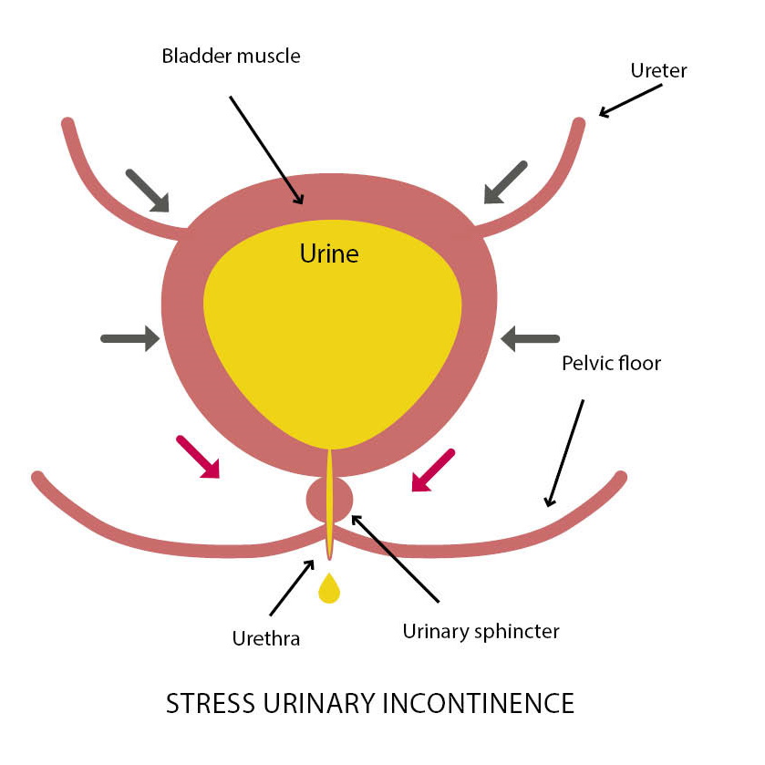 Urinary incontinence